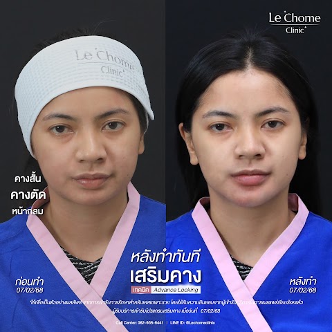 เสริมคาง (ใหม่)