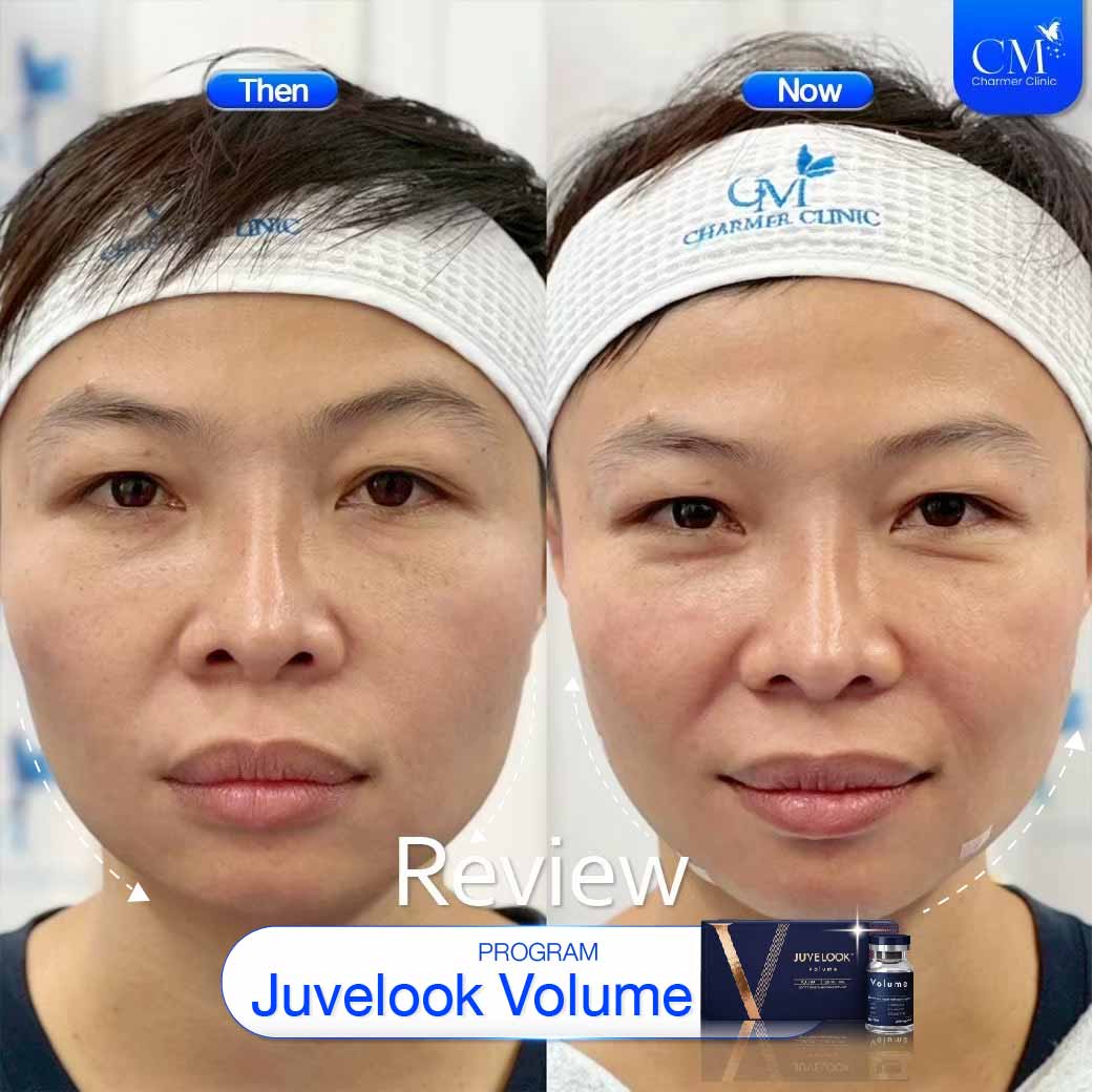 รีวิว Juvelook Volume Before After