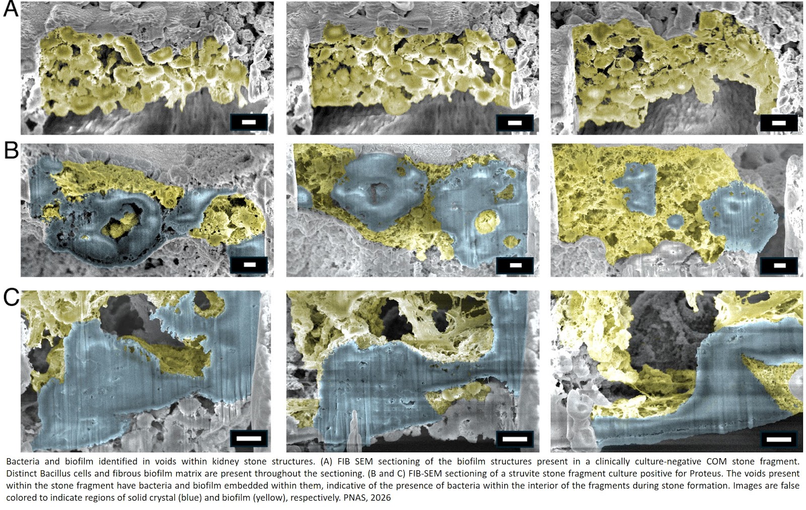 Intercalated bacterial biofilms are intrinsic internal components of calcium-based kidney stones