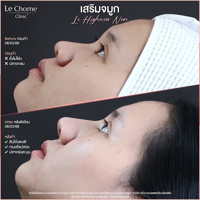 รีวิวเสริมจมูก — เสริมจมูก