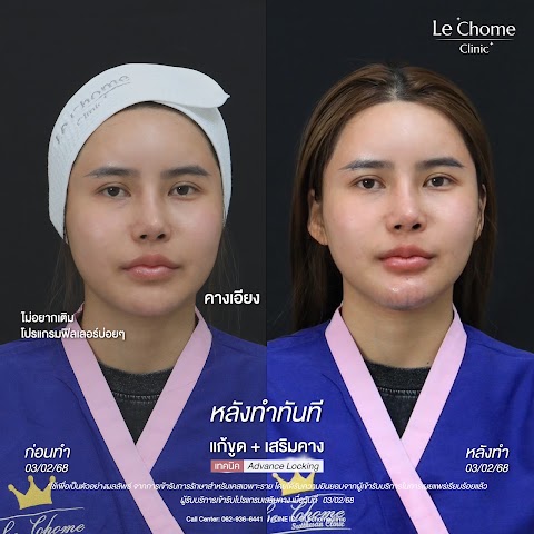 แก้ขูดฟิลเลอร์+เสริมคาง