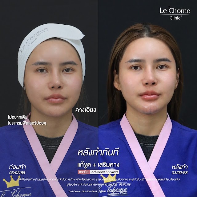 รีวิวเสริมคาง — แก้ขูดฟิลเลอร์+เสริมคาง