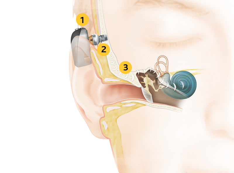Schéma anatomique implant BAHA