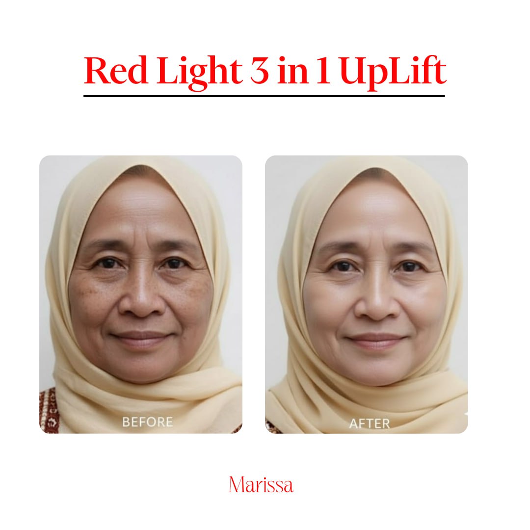 Marissa Red Light 3-in-1 Uplift Before and After