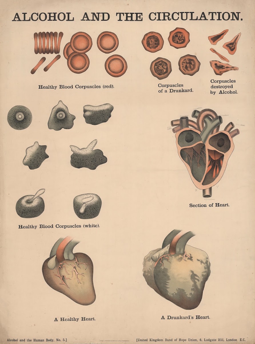 Alcohol and the Circulation 1890