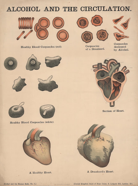 Alcohol and the Circulation 1890