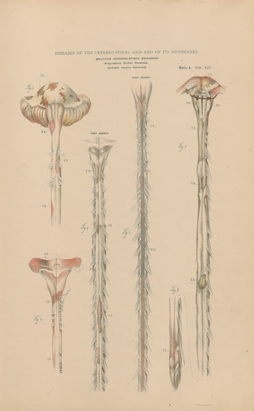 Multiple Cerebro Spinal Sclerosis Progressive Bulbar Paralysis Incipient Bulbar