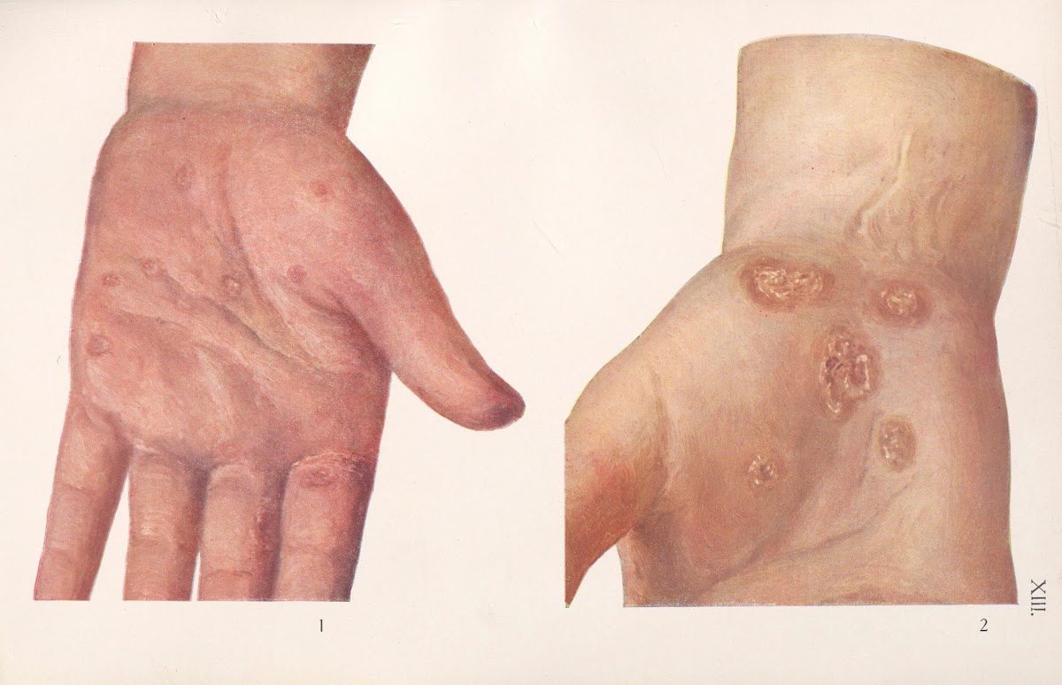 Venereal diseases  Syphilis Pl13 1908