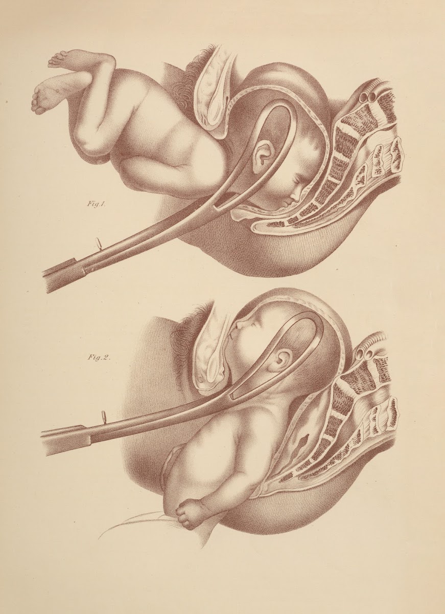 Artificial LaborApplication of the Forceps 1885