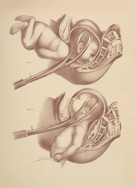 Artificial LaborApplication of the Forceps 1885