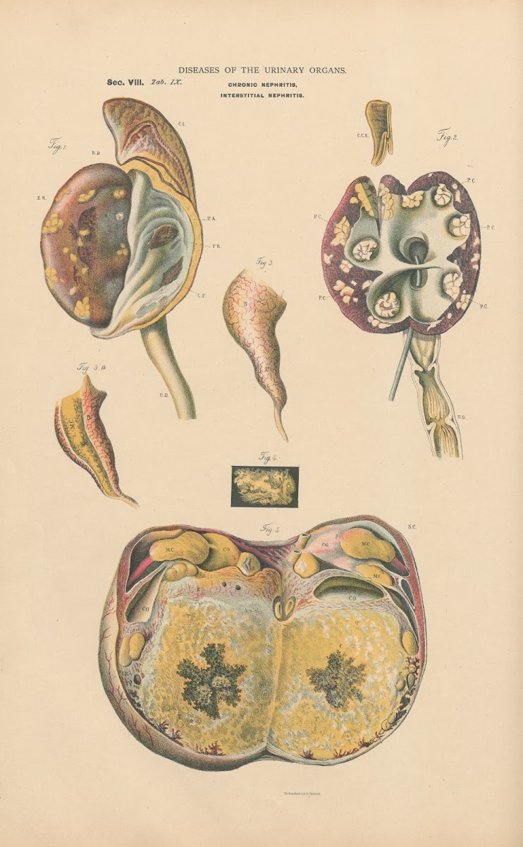 Chronic Inflammation Of Right Kidney And Ureter Cancer Of Kidney And Ureter 1888