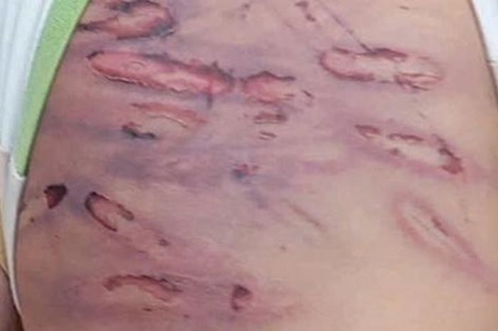 Sức khỏe của bé trai 2 tuổi bị mẹ ruột và cha dượng bạo hành giờ ra sao? - Báo Sức Khỏe &amp; Đời Sống