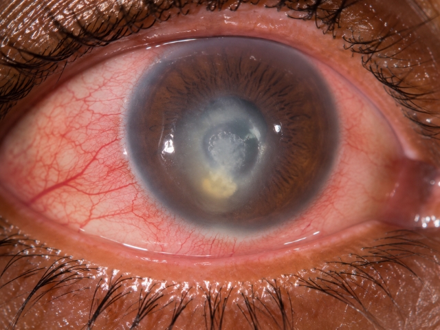 Slit-lamp examination for corneal ulcer at Dayal Eye Centre