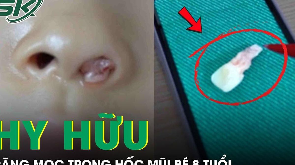 Răng mọc trong hốc mũi bé gái 8 tuổi - Báo Sức Khỏe &amp; Đời Sống