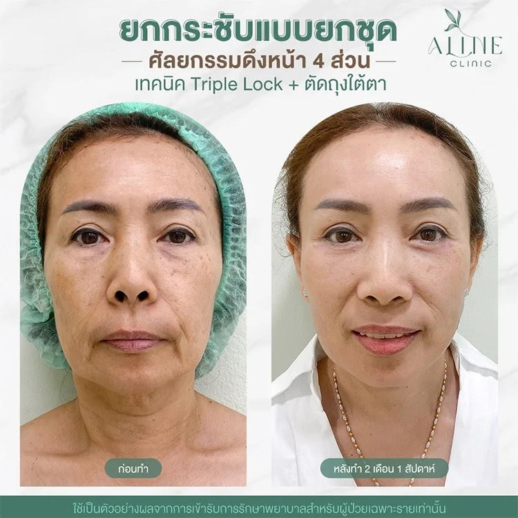 รีวิวผ่าตัดดึงหน้า ALINE Clinic