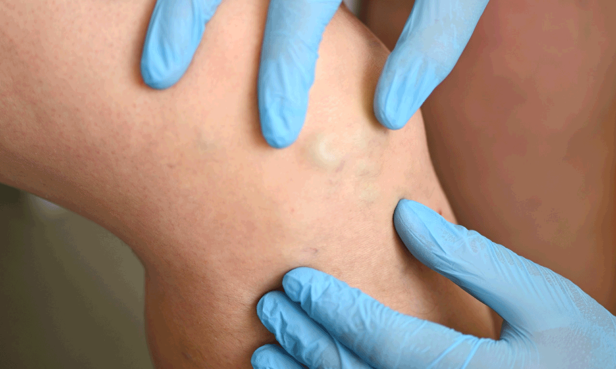 La flebología vascular se globaliza: Alianza internacional impulsa formación médica continua