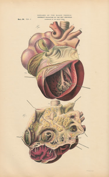 Hypertrophy And Dilatation Of Left Ventricle 1888
