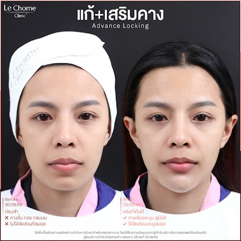 แก้ซิลิโคน+เสริมคาง