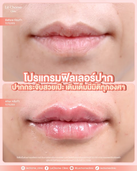 ฟิลเลอร์