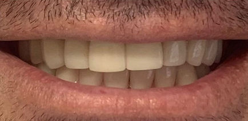 Depois — Facetas, caso 4