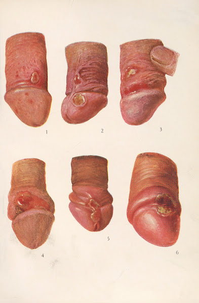Venereal diseases  Syphilis Pl01 1908