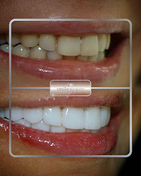 ZEvolution veneers cosmetic dentistry result Dr Habib Zarifeh Smile Infinity New York patient case 2
