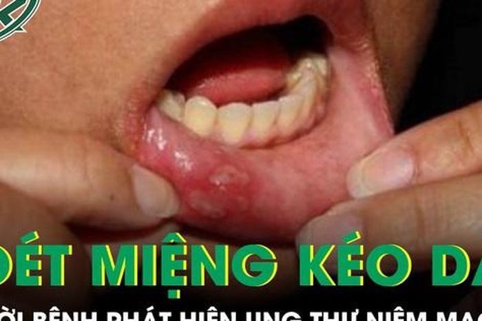 Loét miệng kéo dài, người bệnh phát hiện ung thư niêm mạc má - Báo Sức Khỏe &amp; Đời Sống