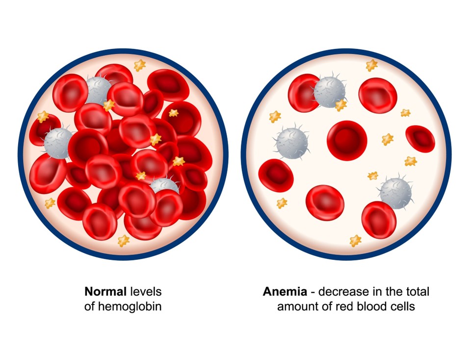 ANAEMIA