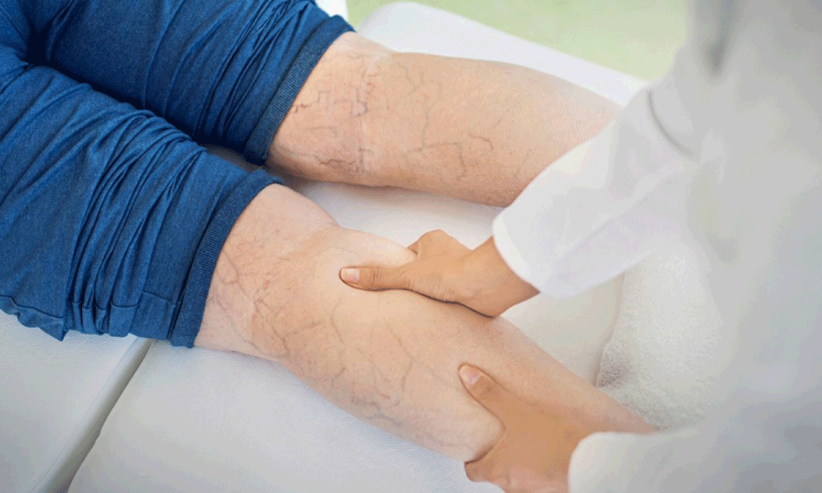 Flebología y patología venosa: una especialidad clave para la salud vascular en América Latina