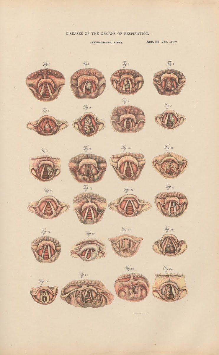 Laryngoscopic Views 1888