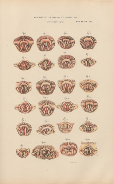 Laryngoscopic Views 1888