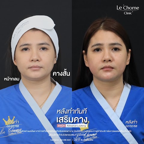 เสริมคาง (ใหม่)