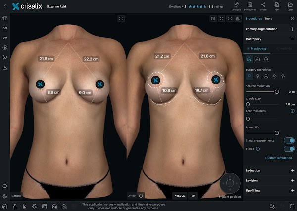 Simulation mammaire 3D dans l’application Crisalix avec l’outil « Analyse » ouvert.