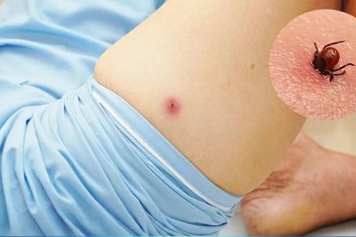 Tổn thương gan, phổi chỉ từ nốt loét nhỏ do mò đốt - Báo Tri thức &amp; Cuộc sống