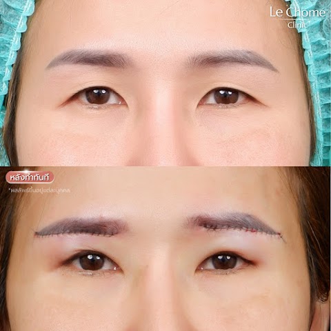 ตา 2 ชั้น