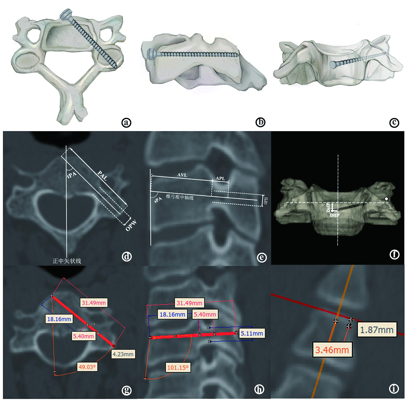 Morphological measurement of anterior cervical pedicle screw placement assisted by Mimics three-dimensional CT reconstruction