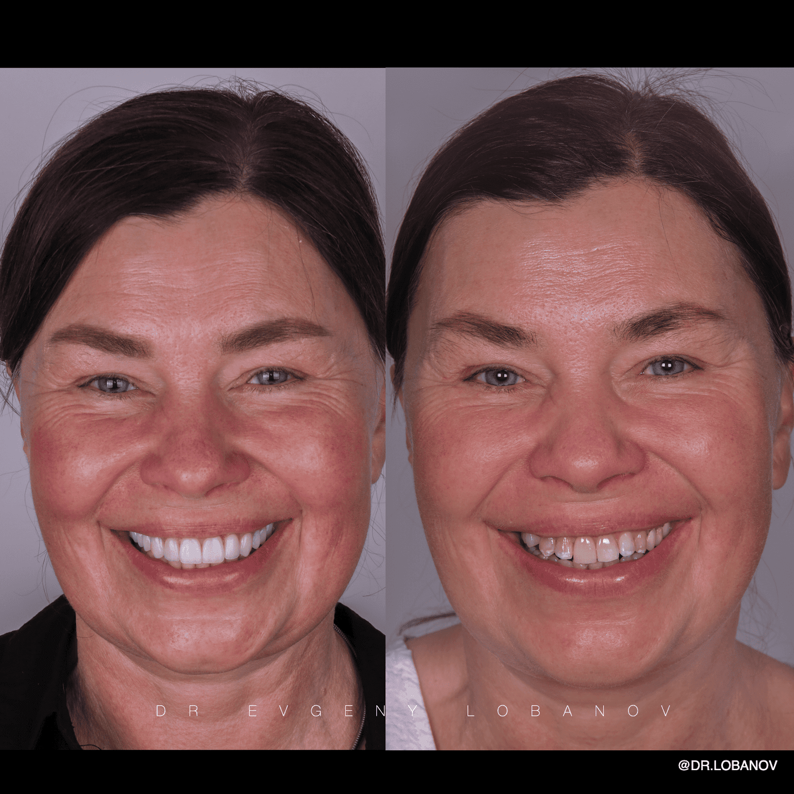 До и после установки керамических виниров