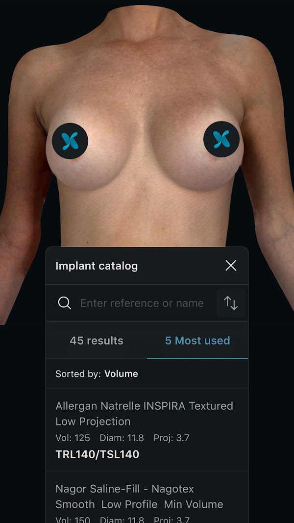 Simulation mammaire 3D dans l’application Crisalix avec le « catalogue d’implants » ouvert. 1080px x 1920px.