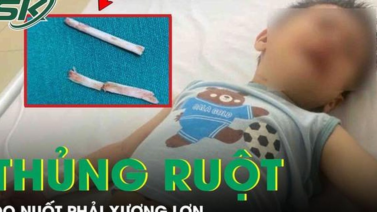 Hai trẻ bị thủng ruột, viêm phúc mạc do nuốt phải xương lợn - Báo Sức Khỏe &amp; Đời Sống