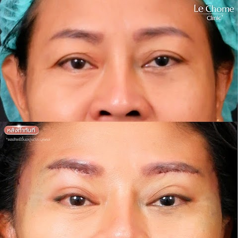 ตา 2 ชั้น