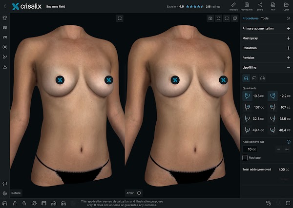 Simulation mammaire 3D dans l’application Crisalix avec l’outil de procédure « Lipofilling » ouvert.