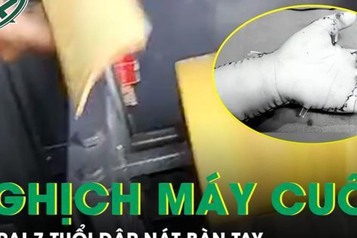 Bé 7 tuổi ở Lào Cai bị máy cuốn dập nát bàn tay do nghịch máy bào quế tự chế - Báo Sức Khỏe &amp; Đời Sống