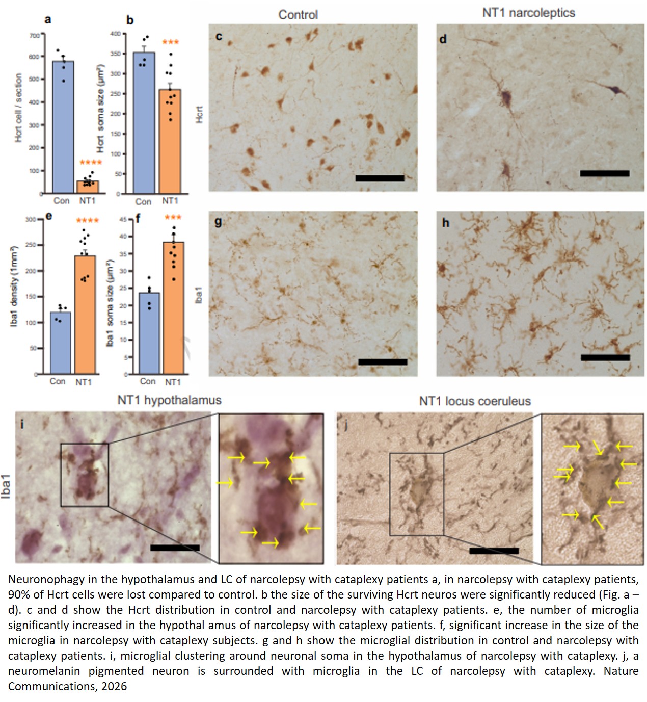 Human narcolepsy is linked to degeneration of both locus coeruleus and hypocretin neurons