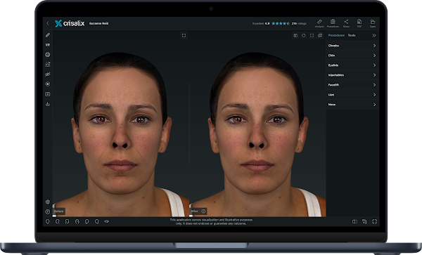 Ordinateur portable affichant l’interface de l’application Crisalix avec une simulation de visage 3D.