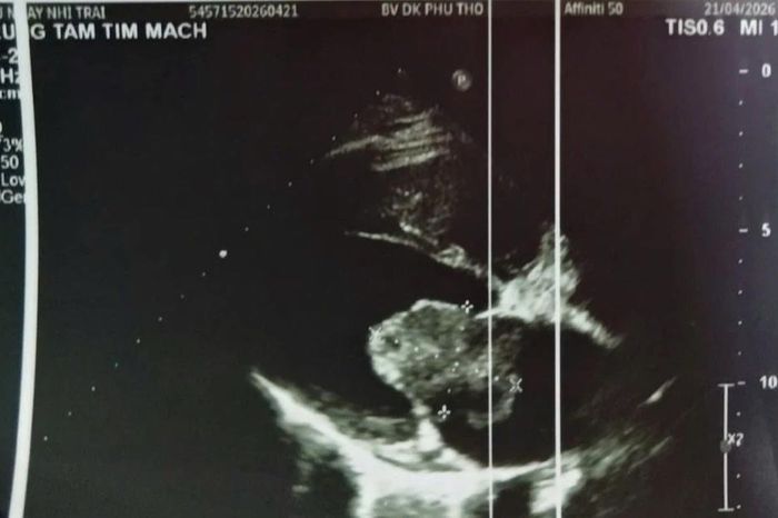 U nhầy tim- thủ phạm thầm lặng gây đột quỵ ở người trẻ - Báo Tri thức &amp; Cuộc sống