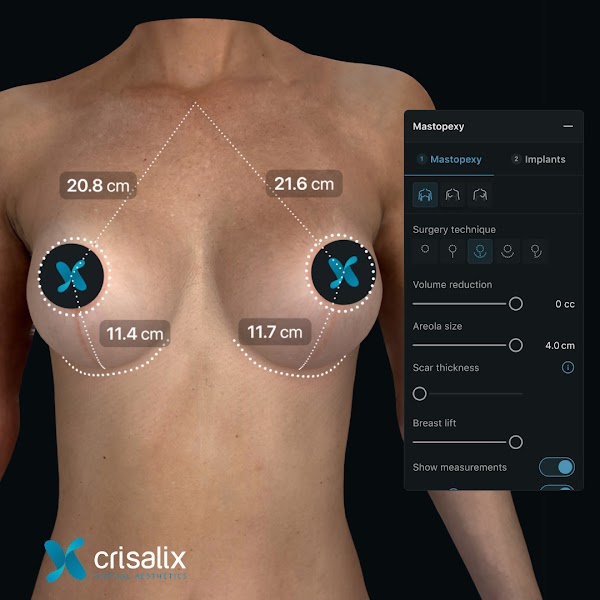 Simulation mammaire 3D dans l’application Crisalix avec l’outil de procédure « Mastopexy » ouvert. 1080px x 1080px.