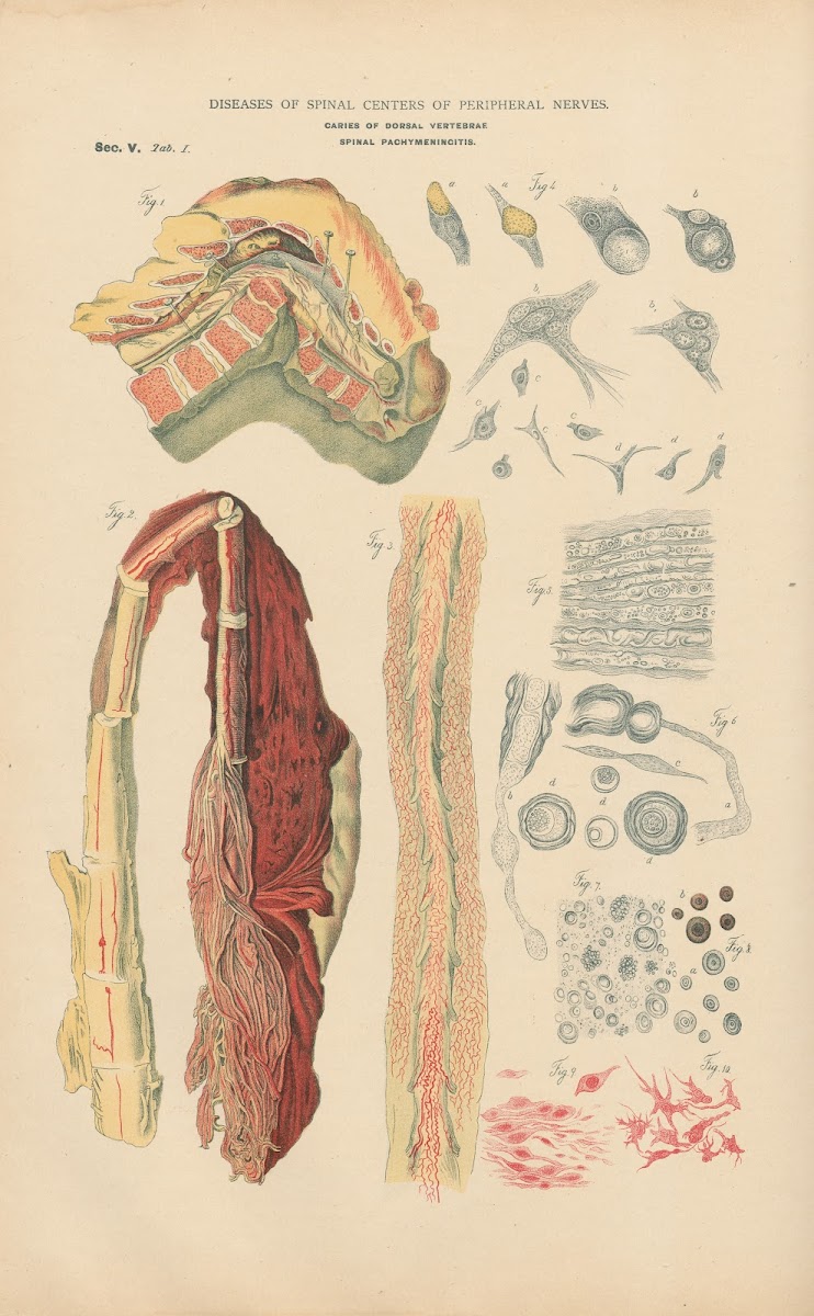 Caries Of Middle Dorsal Vertebra With Posterior Kyphosis 1888