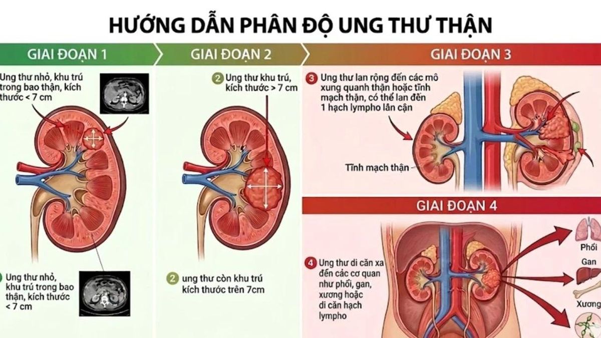 Đau lưng kéo dài, người đàn ông 45 tuổi phát hiện ung thư thận - Báo Tri thức &amp; Cuộc sống