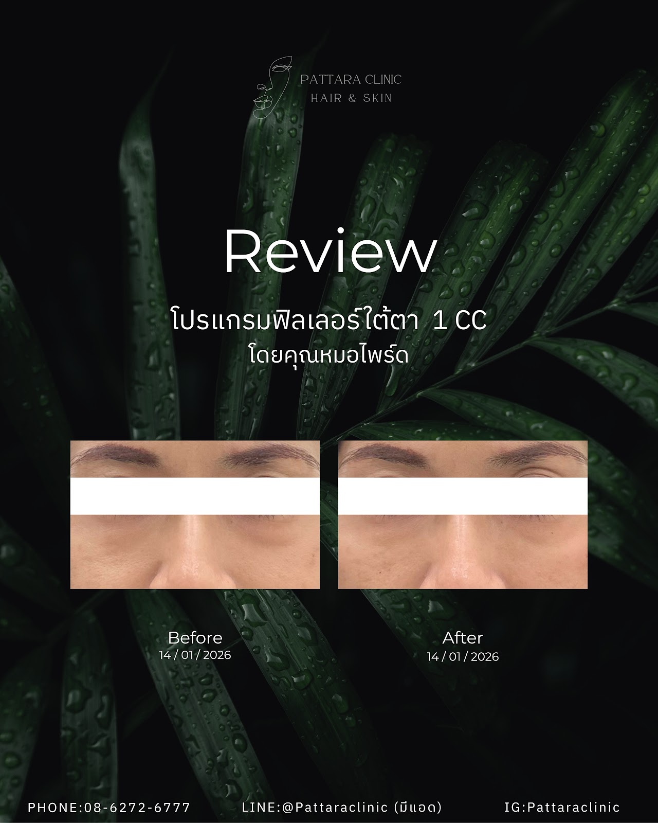 รีวิวฟิลเลอร์ใต้ตา เคสที่ 2