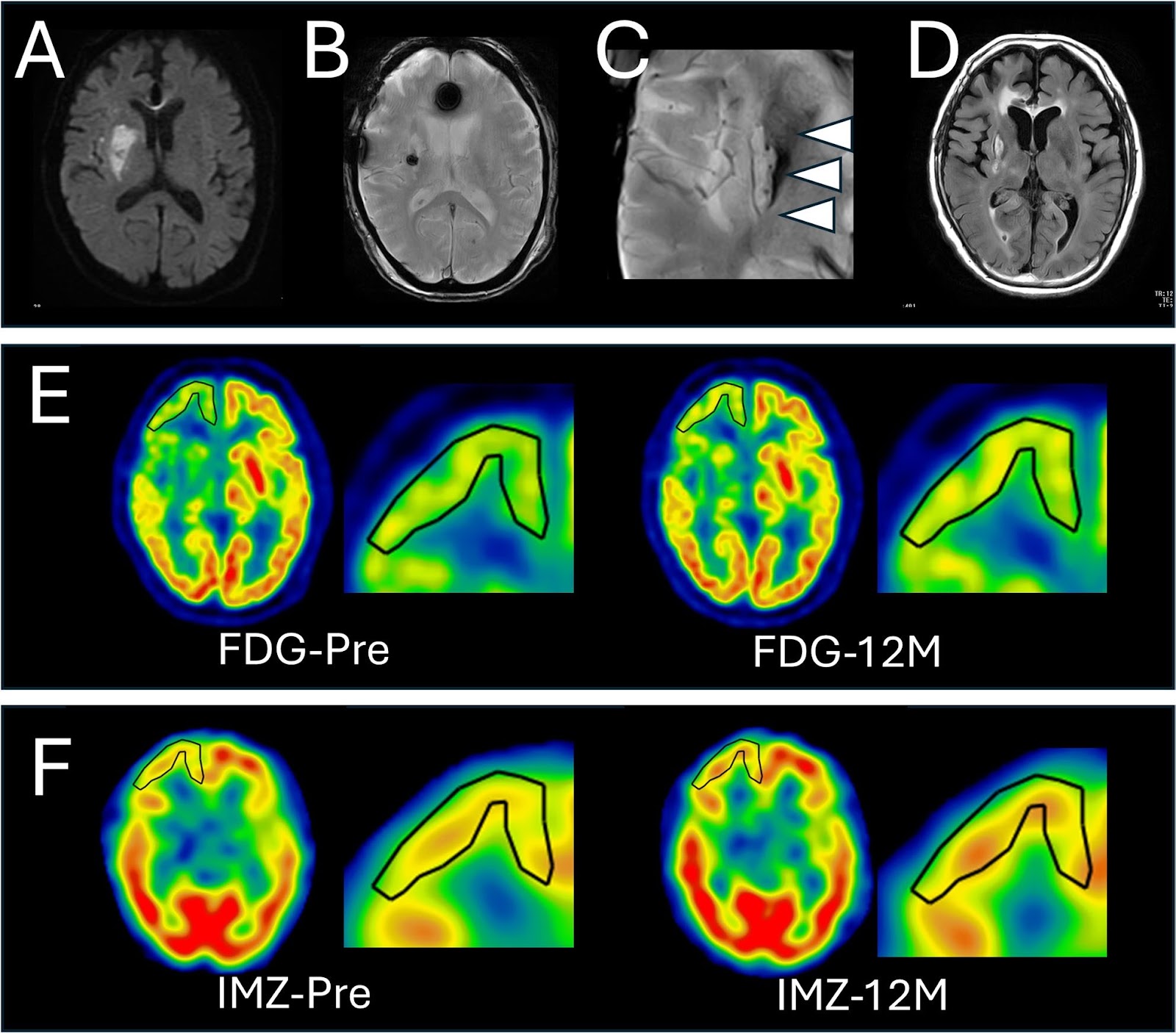Serial brain FDG-PET and IMZ-SPECT following intracerebral MSC transplantation in patients with subacute ischemic stroke